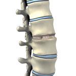 Anterior Lumbar Interbody Fusion (ALIF)