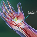 Carpal Tunnel Syndrome