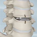 Cervical Disc Arthroplasty