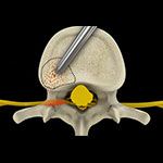 Cervical Foraminotomy