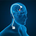 Deep Brain Stimulation