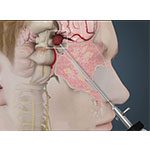 Endoscopic Pituitary/ Extended Trans-sphenoidal Tumor Resection