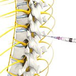 Epidural Spinal Injection