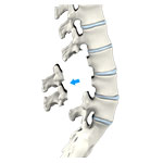 Lumbar Laminectomy