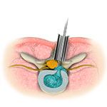 Metrx Discectomy/Decompression