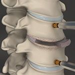 Minimally Invasive Cervical Discectomy