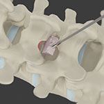 Minimally Invasive Lumbar Discectomy