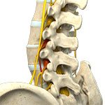 Nerve Compression Syndrome