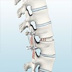 Posterior Lumbar Interbody Fusion (PLIF)