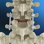 Posterolateral Lumbar Fusion