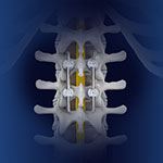 Spinal Fusion