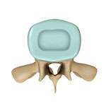 Spinal Stenosis