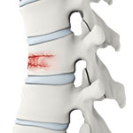 Spinal Trauma