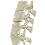 Transforaminal Lumbar Interbody Fusion (TLIF)